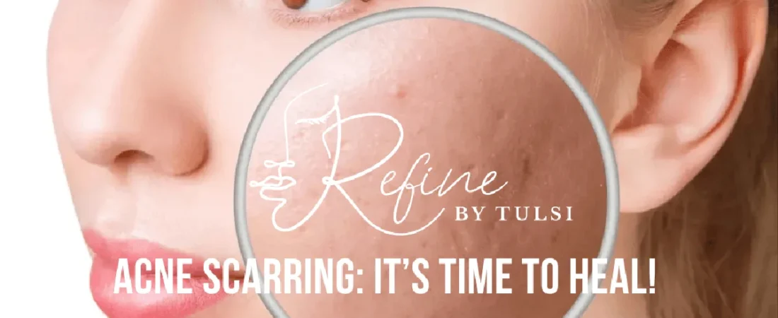 The 5 Types of Acne Scars — and How Each Is Treated