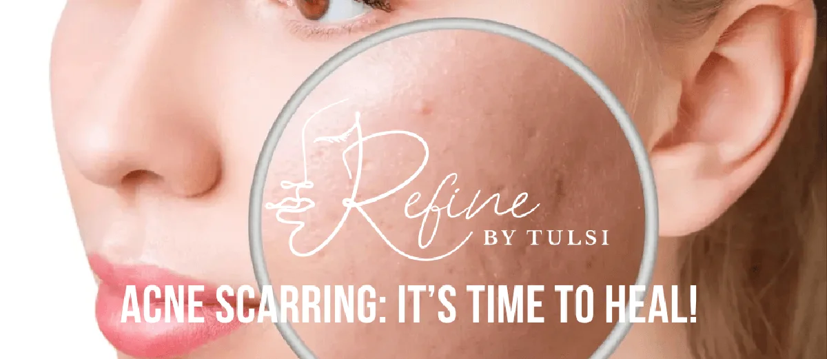 The 5 Types of Acne Scars — and How Each Is Treated
